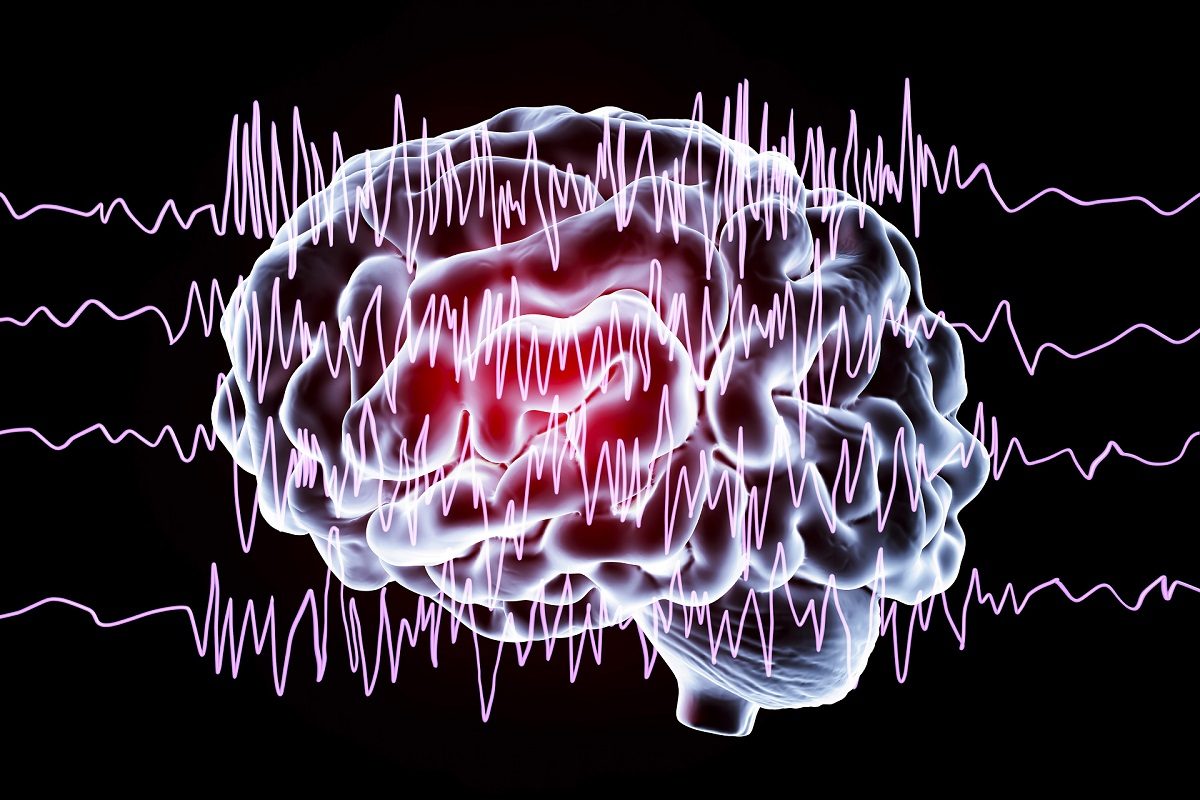 concepto sobre la epilepsia en el cerebro