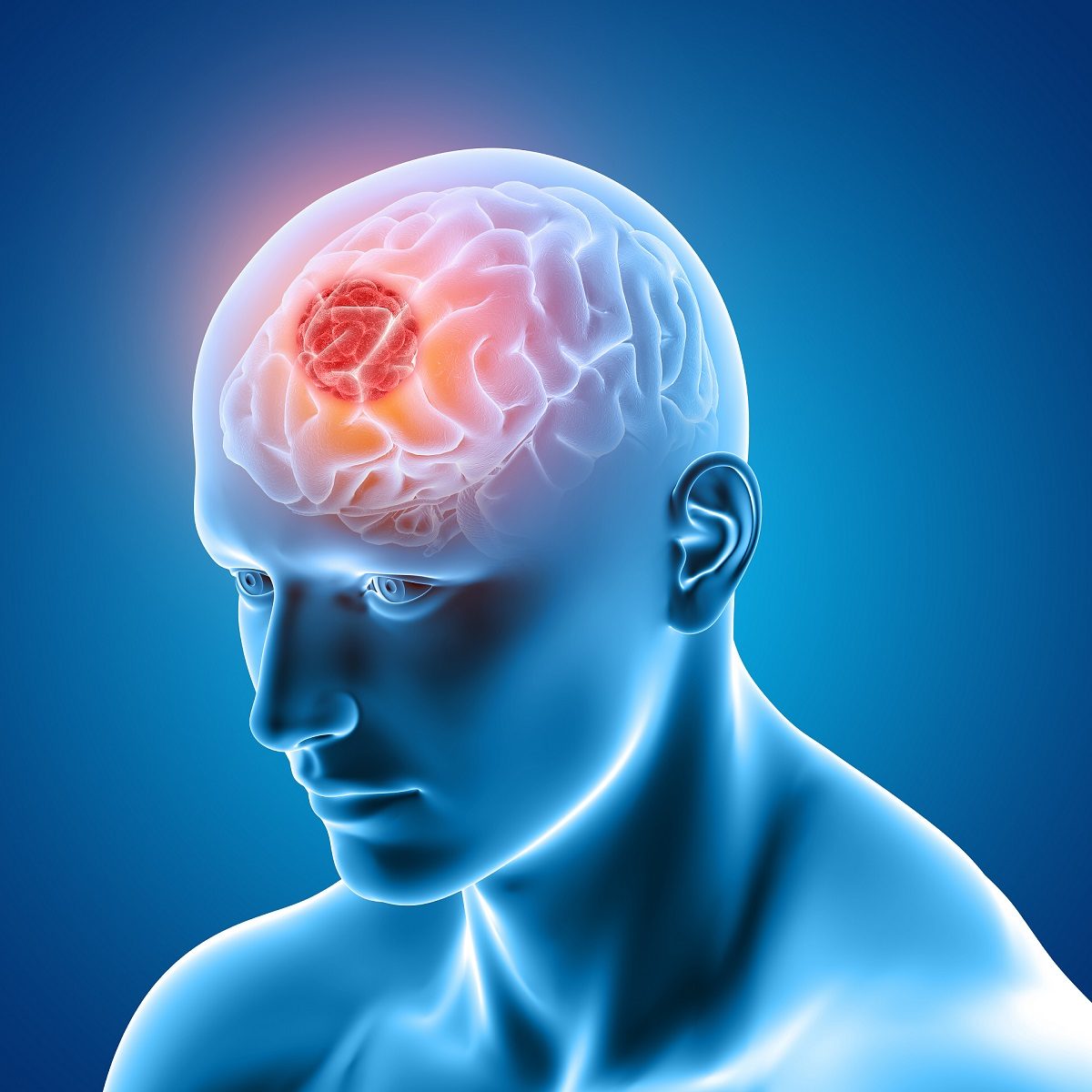 Figura en 3D de una persona con un problema en el cerebro